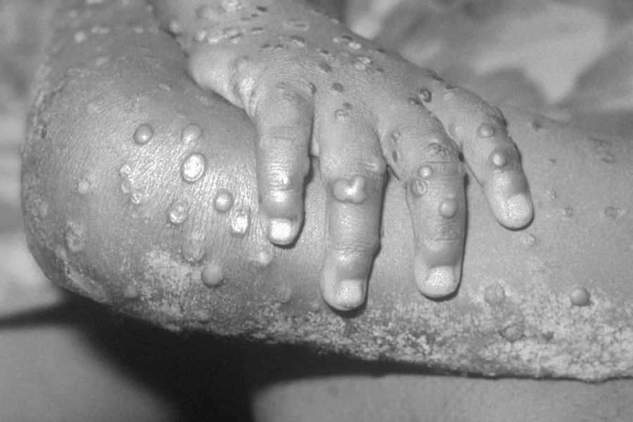 Experto asegura que la probabilidad de contraer la viruela del mono es muy baja