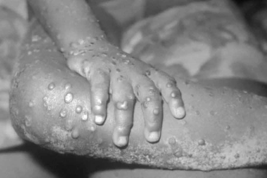 Ciudadano chileno se contagia con viruela del mono en Europa