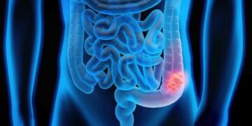 Qué es el cáncer colorrectal, cada vez más común entre adultos jóvenes (y cuáles son sus síntomas)