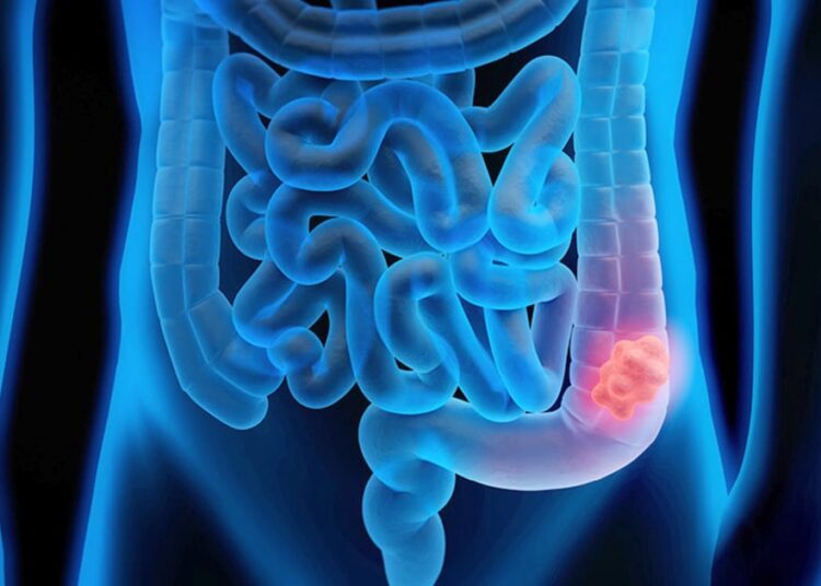 Qué es el cáncer colorrectal, cada vez más común entre adultos jóvenes (y cuáles son sus síntomas)